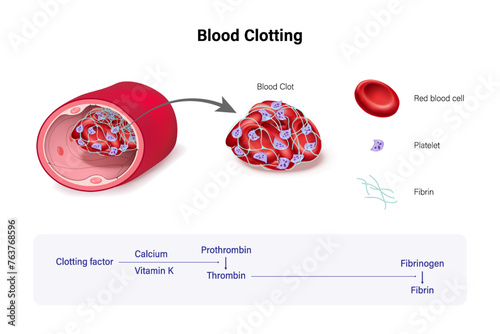 Blood clotting. Clotting chain reaction in blood. Red blood cell, Platelet and Fibrin.
