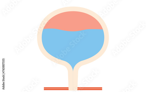 Medical illustration of overactive bladder, a condition in which the normal bladder holds back urine