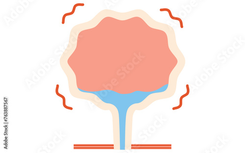 Medical illustration of overactive bladder, a condition in which the bladder is contracting even when there is no urine in the bladder