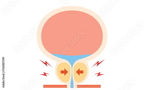 Medical illustration of benign prostatic hyperplasia, enlarged prostate