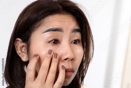 Asian woman suffering from eye inflammation feeling pain ,redness and swollen