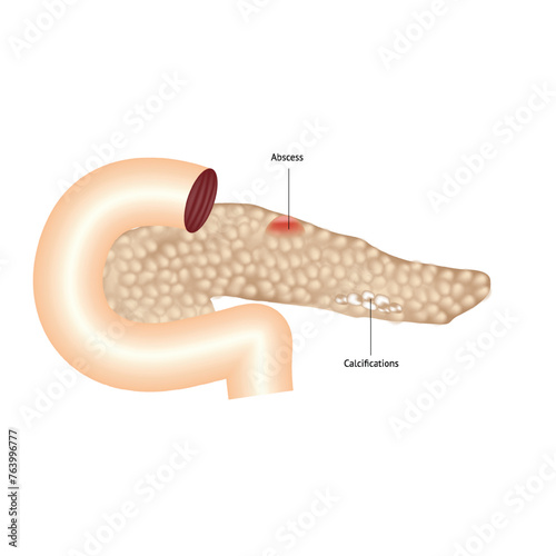 Pancreatic pathologies, calcifications and abscesses