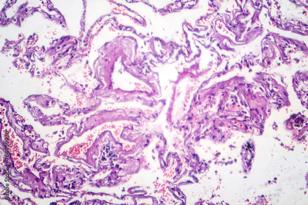Smoker's lung, light micrograph Smoker's lung, light micrograph