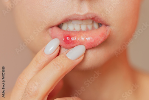 A young woman suffering from stomatitis pulls back her lower lip with both fingers, shows an ulcer of stomatitis in the acute stage on the mucous membrane of the mouth. Oral problems photo