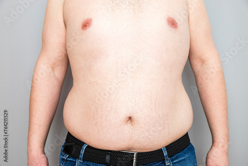 Overweight Caucasian Man's Belly, Health Concept
