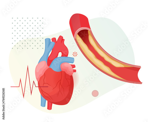 Atherosclerosis Stages - Cholesterol Plaque Buildup in Heart - Stock Illustration