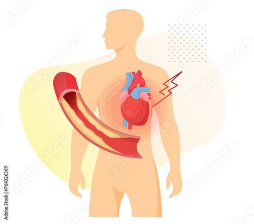 Atherosclerosis Stages - Cholesterol Plaque Buildup in Heart - Stock Illustration