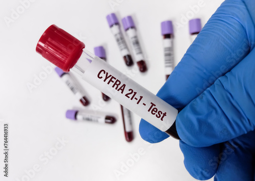 Blood sample for CYFRA-21-1 test, biologic marker of non-small cell lung cancer. cytokeratin 19 fragment test. photo