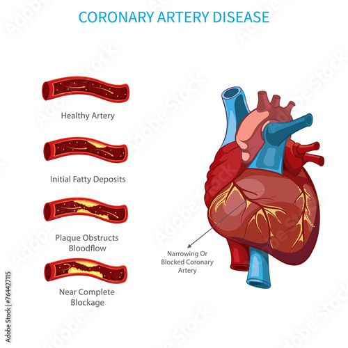In Coronary artery disease, Narrowing of coronary arteries occur, which increases risk of heart attack