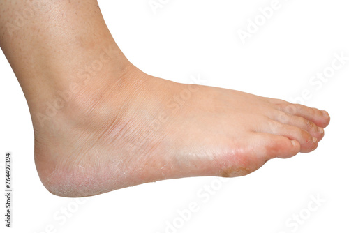 The skin on the feet peels off due to excessive sweating, pronation of the feet. photo