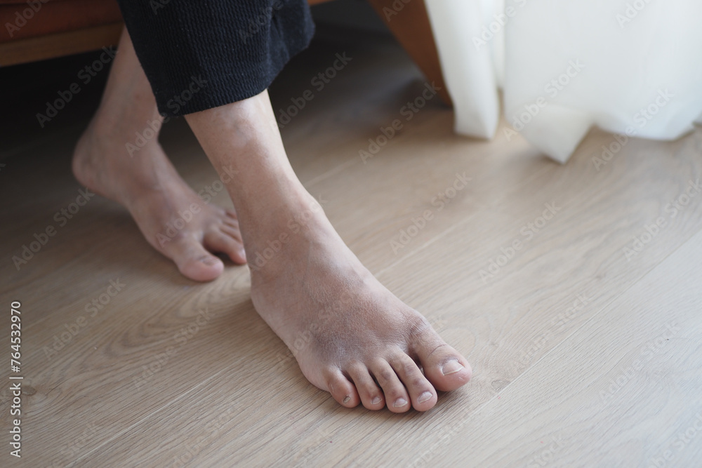 close up of women feet with swelling close up of women feet with swelling