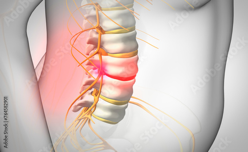 Spinal disc herniation, illustration photo
