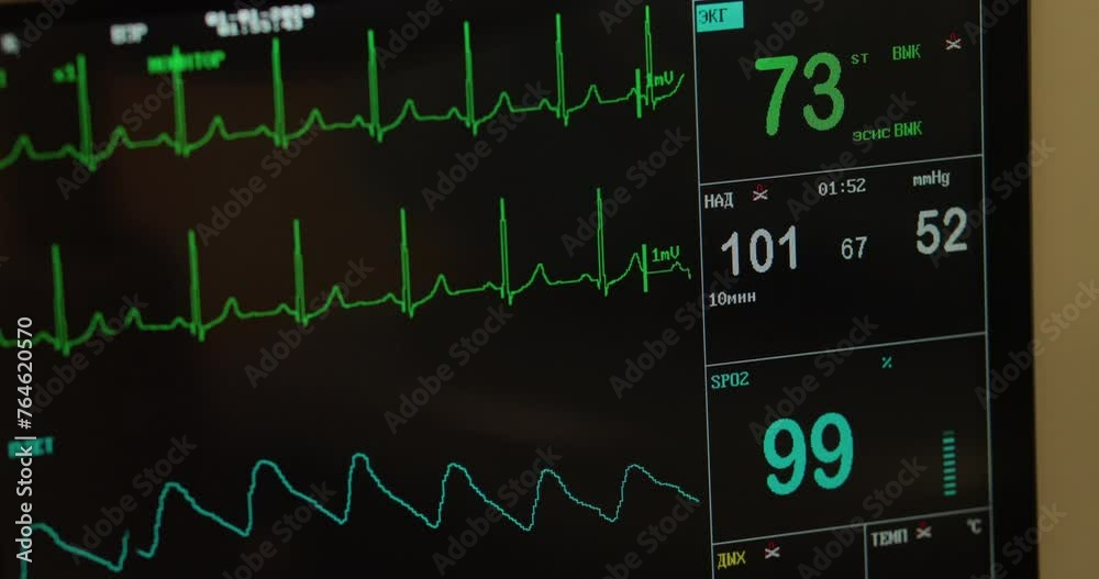 Electronic Health Monitor Machine Checks Vital Signs Of Ill Patient. Electronic Machine Detects Decline In Vital Signs Of Patients Heart. Electronic Machine Monitors Vital Signs Of Patient. ECG