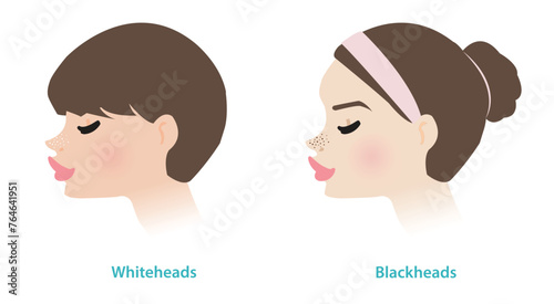 Cute women with whiteheads and blackheads acne on noses vector illustration. Whiteheads and blackheads are both types of non inflammatory acne, they are forms of comedones. The pore is closed or open.