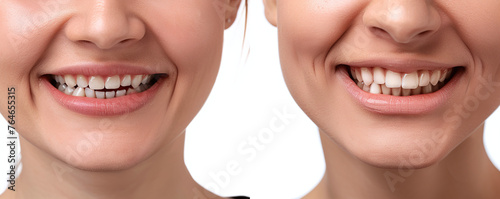 Collage of young woman near collage with health teeth. Over white background. Young woman before and after gingivoplasty procedure on white background  closeup. Banner design.Ai