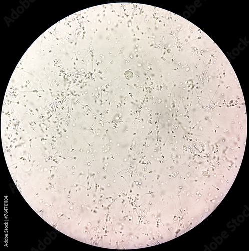 Sperm morphology. Semen photo under microscope. Micrograph showing spermatozoon's, Normozoospermia