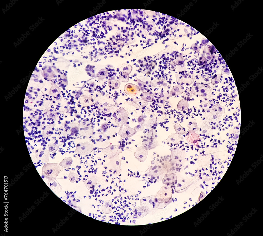 Paps smear: Inflammatory smear with HPV related changes. Cervical cancer. SCC Paps smear: Inflammatory smear with HPV related changes. Cervical cancer. SCC