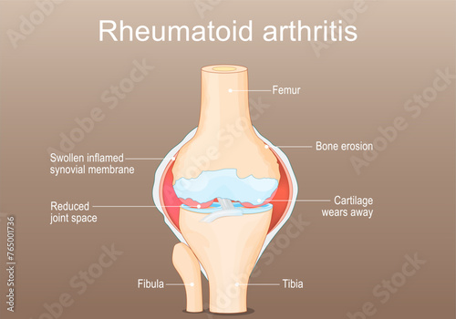 Rheumatoid Arthritis. RA of a knee joint