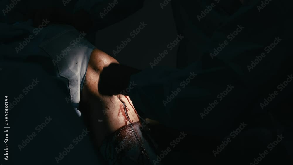 Close-up of professional surgeons performing an operation. During the operation, doctors use modern surgical instruments and equipment. Medical staff working in a hospital operating room. Close-up of professional surgeons performing an operation. During the operation, doctors use modern surgical instruments and equipment. Medical staff working in a hospital operating room.