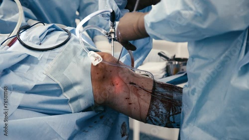The surgeon performs endoscopic manipulations on the kneecap. The doctor performs arthroscopic surgery on the knee or joint in the operating room using modern arthroscopic instruments. photo