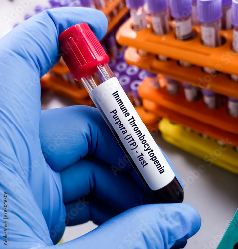 Blood sample for Immune Thrombocytopenic Purpura (ITP) test, idiopathic thrombocytopenic purpura. Thrombocytopenic Disorders, CBC. photo