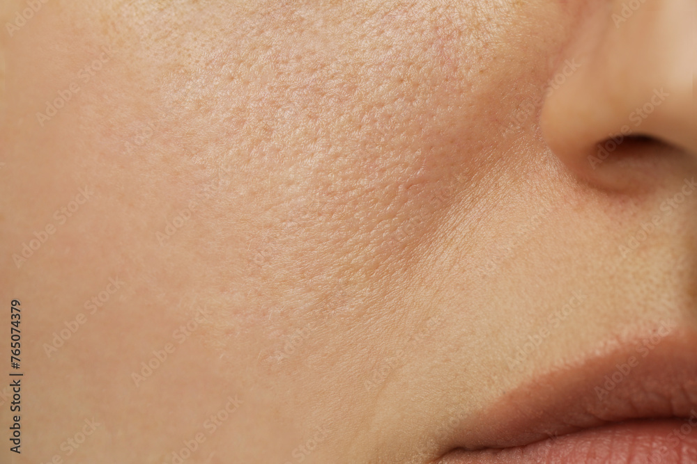 Macro view of woman with dry skin Macro view of woman with dry skin