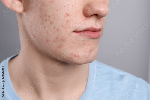 Young man with acne problem on grey background, closeup