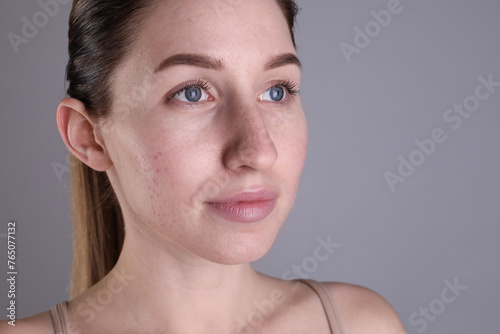 Young woman with acne problem on light grey background. Space for text