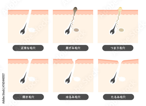 毛穴の種類