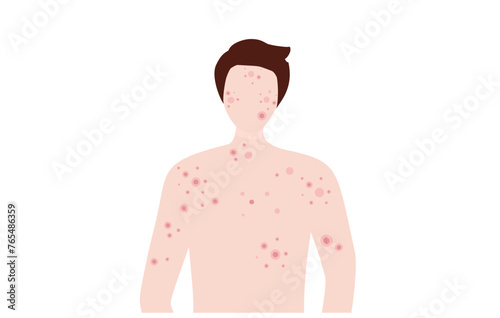 Young man with skin acne, pimples, blackheads vector illustration. Acne skin problem concept