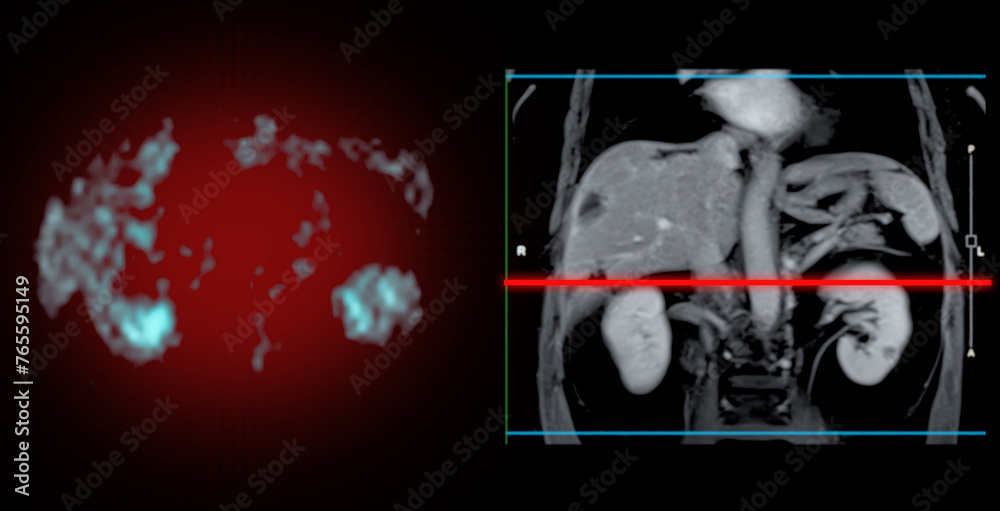 PET MRI of the liver in liver cancer provides precise imaging, aiding ...