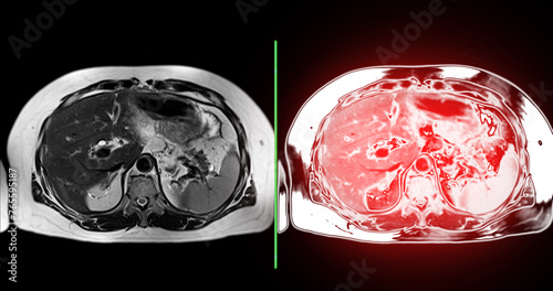 MRI of the upper abdomen  is a non-invasive imaging technique providing detailed visuals of organs like the liver, pancreas, and kidneys in case normal study. photo