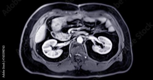MRI of the upper abdomen  is a non-invasive imaging technique providing detailed visuals of organs like the liver, pancreas, and kidneys in case normal study.