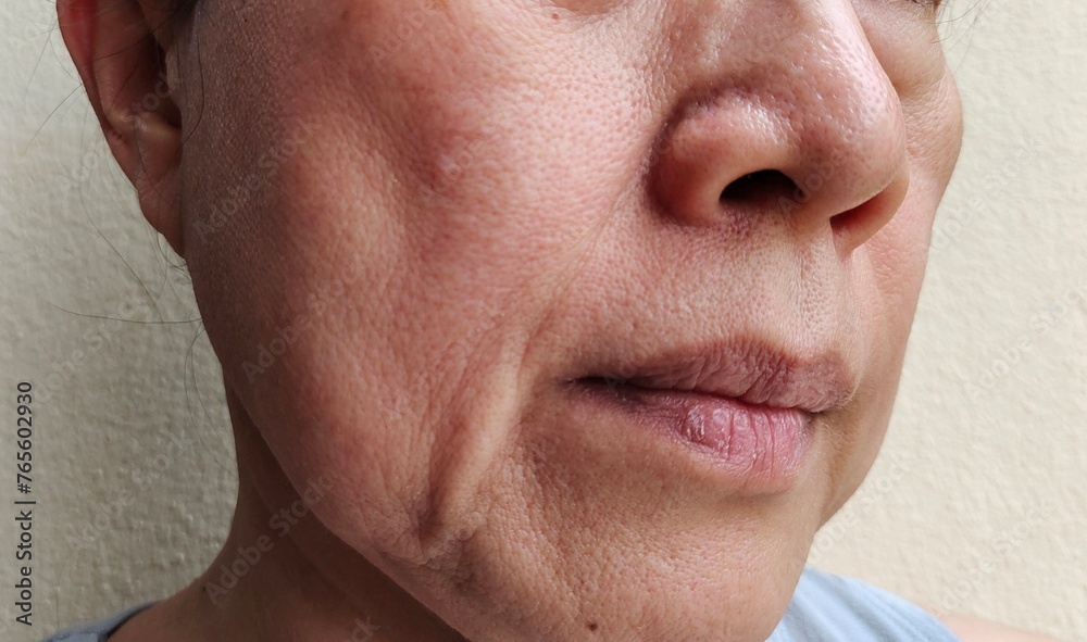 Obraz premium portrait showing the flabbiness and wrinkle beside the mouth, Flabby skin and loose on the face of the woman, health care and beauty concept.