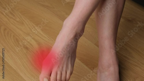 Close-up of a woman's feet with hallux valgus. Leg pain with red light. photo
