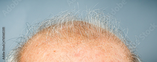close up of  bald head
