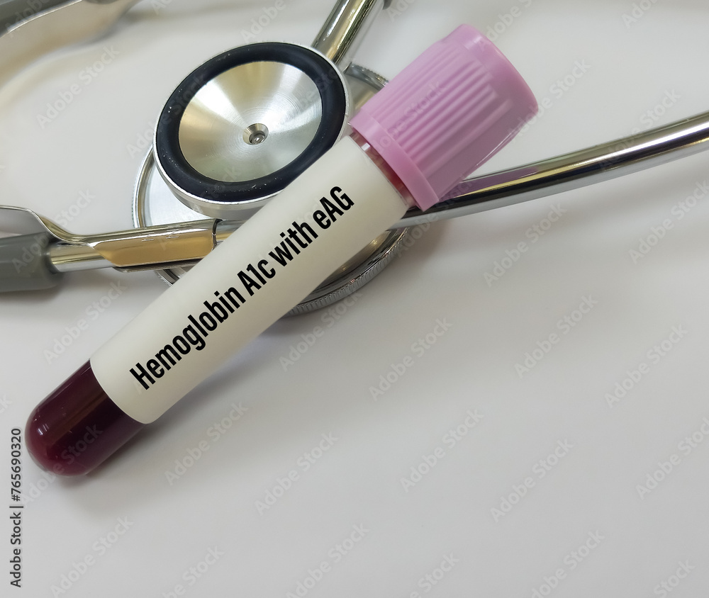 Blood sample for hemoglobin A1c with eAG (HbA1c) test, diabetes
