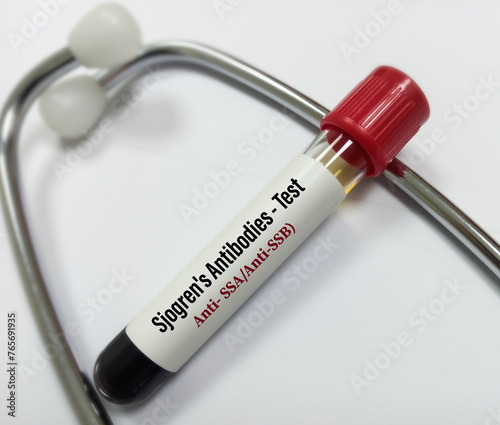 Blood sample for Sjogren's antibody panel test. Sjogren SSA, SSB. Anti-Ro and Anti-La test. photo