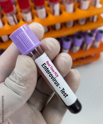 Blood sample for Enterovirus test to diagnosis of myocarditis. Enterovirus PCR test. Myocarditis disease blood test in doctor hand. photo