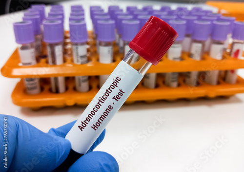 Blood sample for adrenocorticotropic hormone (ACTH) test. Corticoliberin test, Corticotropin-releasing hormone (CRH), is a peptide hormone that activates the synthesis and release of adrenocorticotrop photo