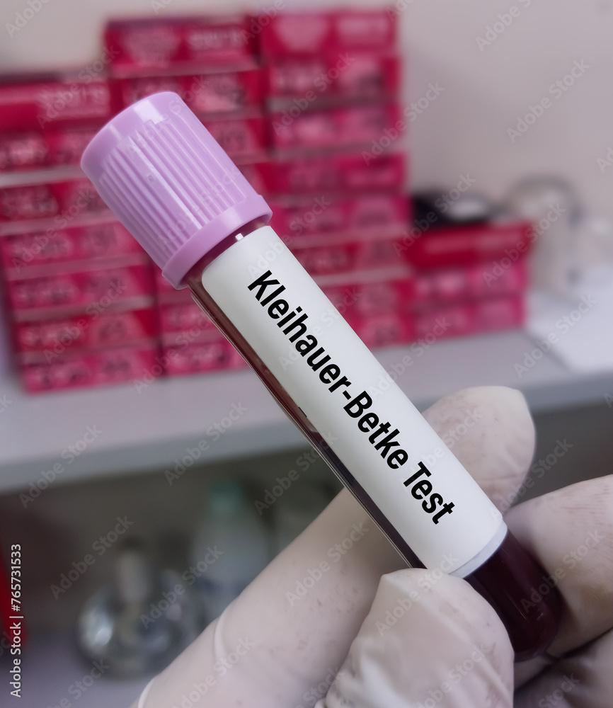 Kleihauer–Betke test or Kleihauer test, is utilized to determine if there is fetal blood in maternal circulation, Foeto-maternal haemorrhage (FMH).