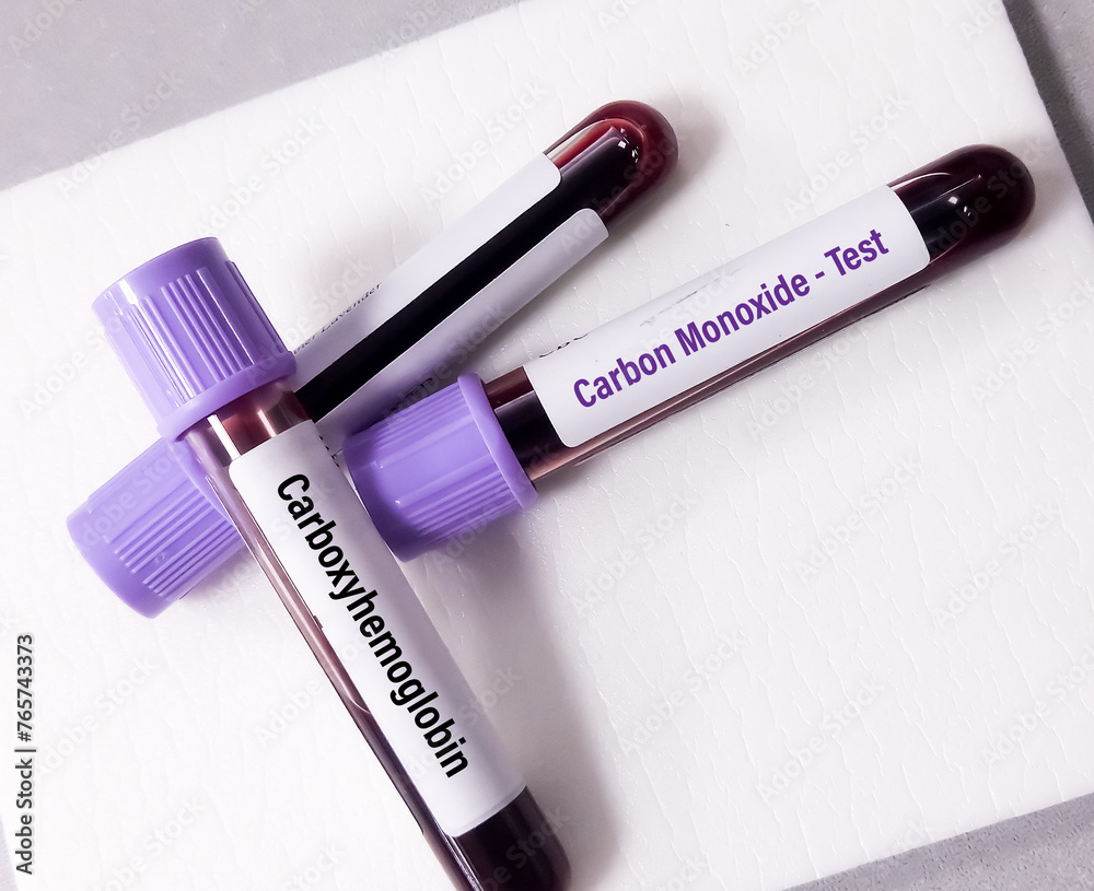 Blood sample for carbon monoxide test which is used to diagnose carbon ...