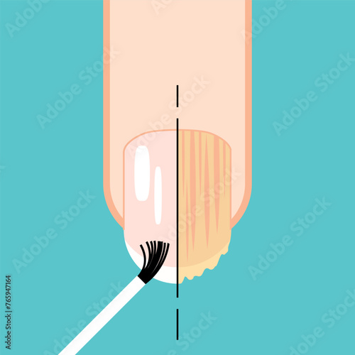 Fungal nail. Nail before and after fungal disease. Fungal and normal nail vector illustration. Nail diseases. Onychomycosis, fungal infection causes, treatment icon