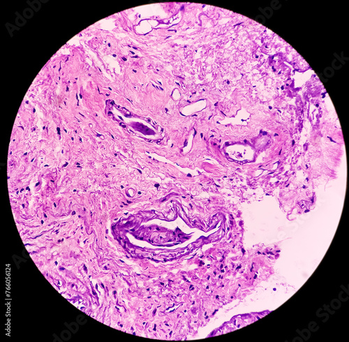 Urachal cyst or Urethral cyst (biopsy). Microscopically show cyst wall of fibrocollagenous tissue lined by transitional epithelium. Skene gland cysts. photo