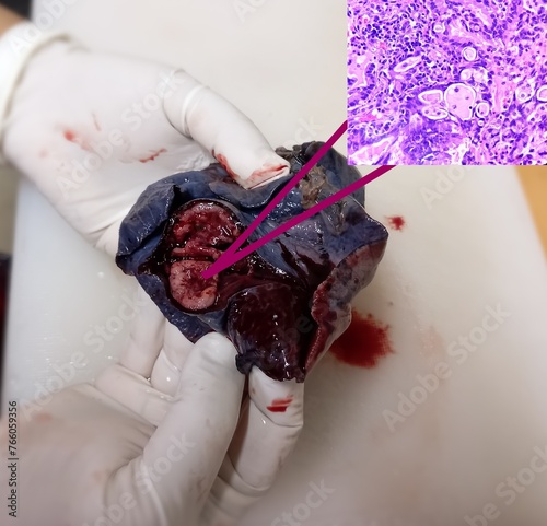 Foto Lung cancer - adenocarcinoma, mucinous type
