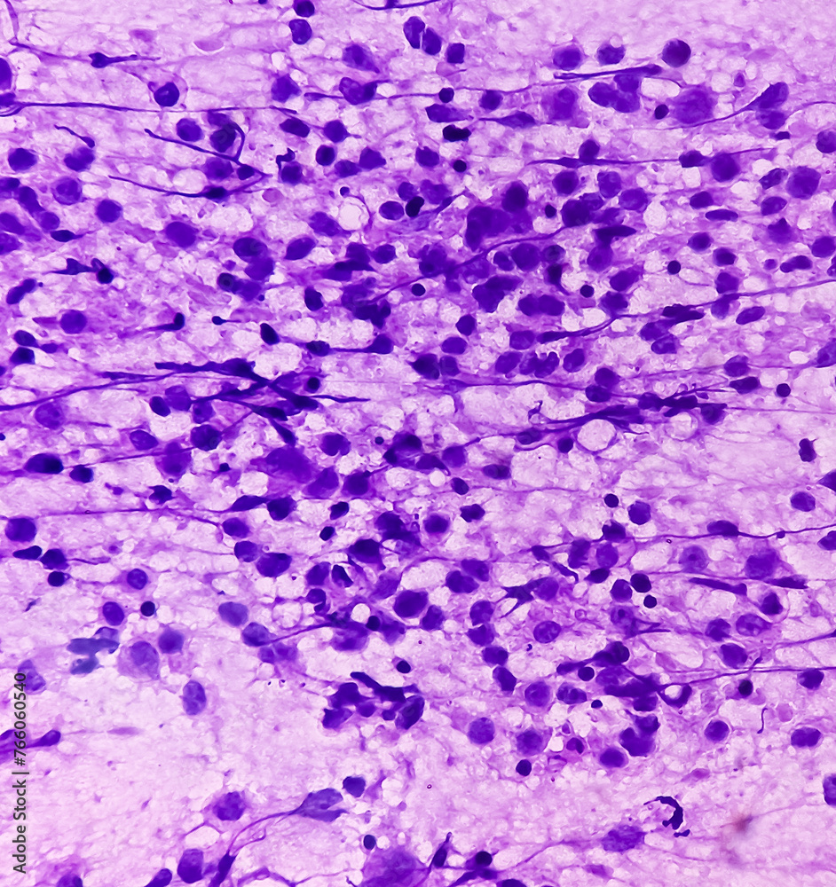 Metastatic plasmacytoma, metastatic undifferentiated sarcoma. Microscopically show cellular material of mostly plasmacytiod cells. atypical mitoses are present. plasma cell tumor.