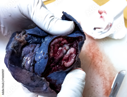Lung cancer - Lung tumor. cut section of left lung for histological examination. sample on surgeon hands.