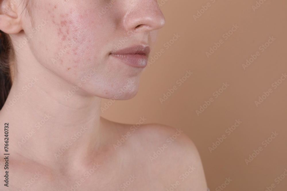 Young woman with acne problem on beige background, closeup. Space for text Young woman with acne problem on beige background, closeup. Space for text