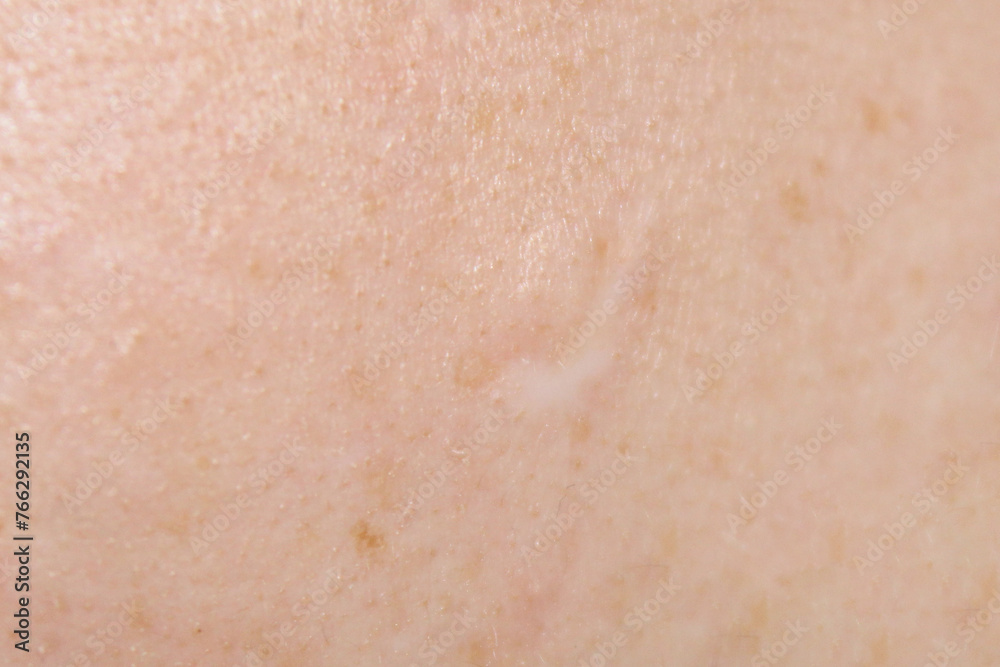 Skin texture and scar. Close-up stock photo of human skin in best quality. Skin texture and scar. Close-up stock photo of human skin in best quality.
