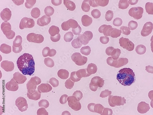 Two eosinophils seen on peripheral blood smear